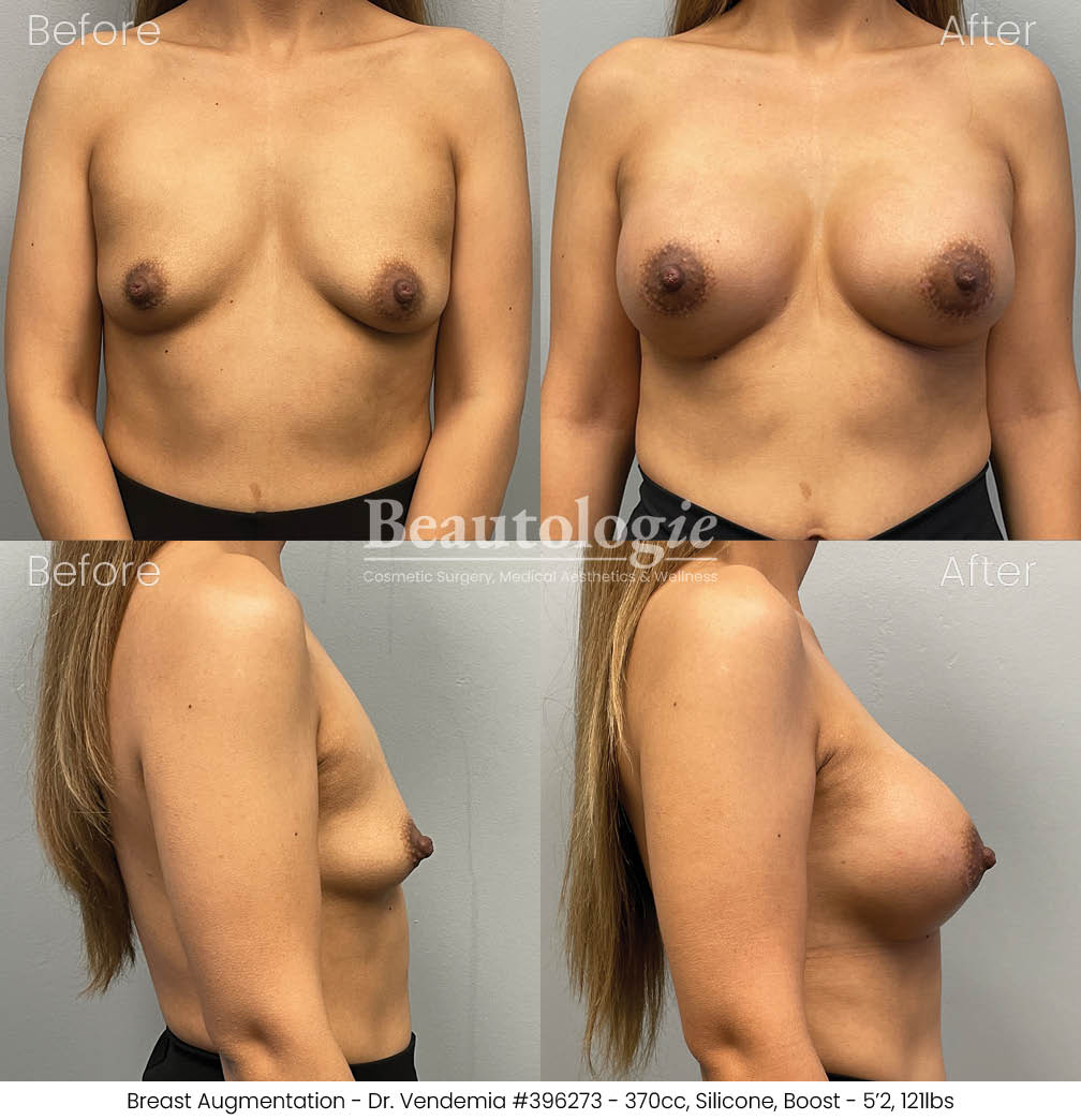 breast-aug-dr-vendemia-14