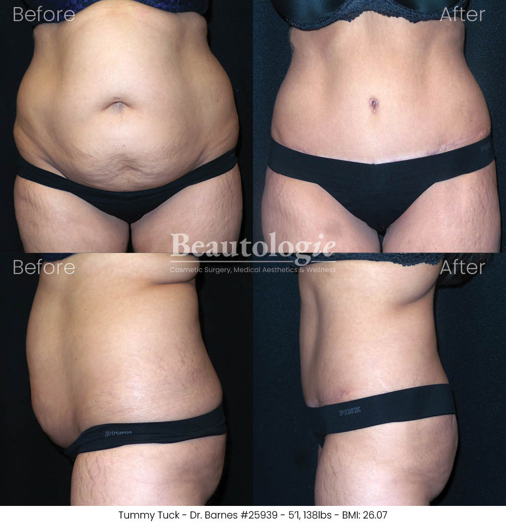 tummytuck-dr-barnes-11