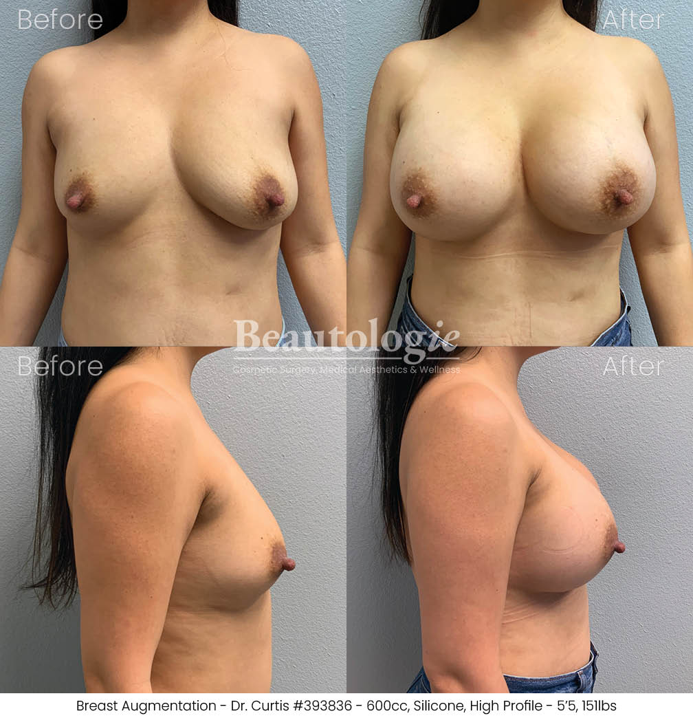 Before-and-afters-breast-breast-augmentation-dr-curtis-41