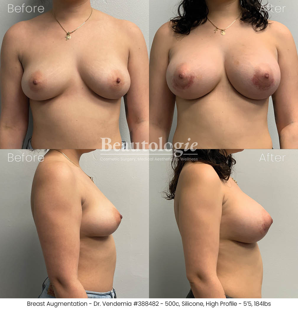 breast-aug-dr-vendemia-16