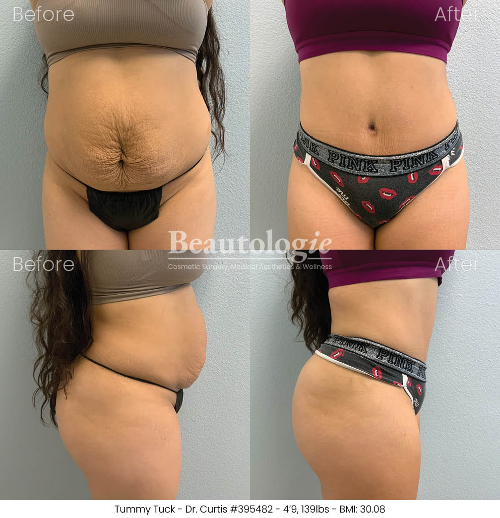 Before-and-afters-body-tummy-tuck-dr-curtis-12
