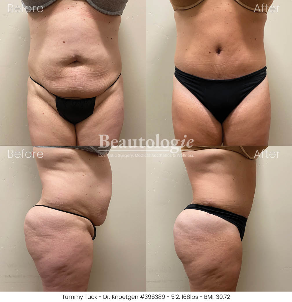 Before-and-afters-body-tummy-tuck-dr-knoetgen-47