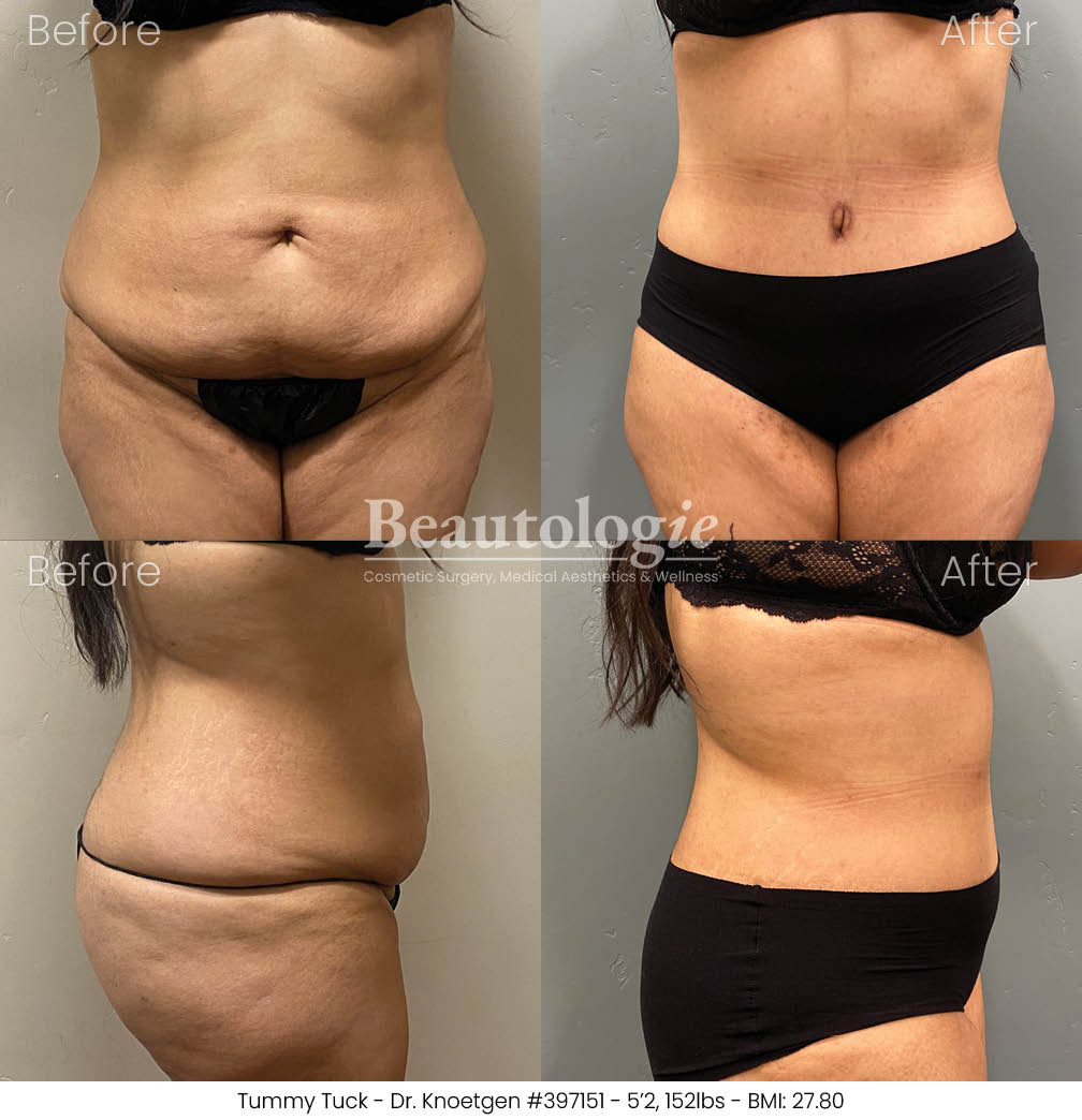 Before-and-afters-body-tummy-tuck-dr-knoetgen-48