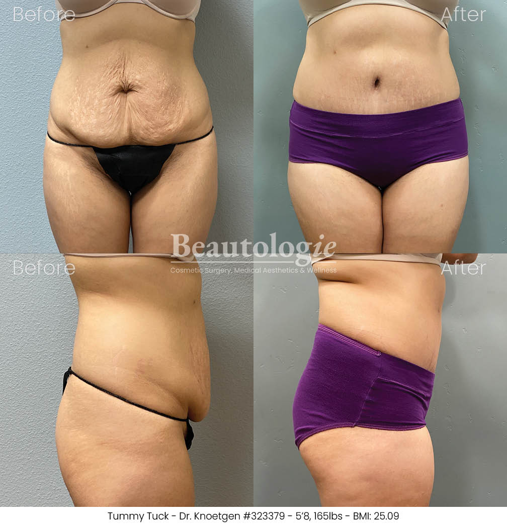 Before-and-afters-body-tummy-tuck-dr-knoetgen-49