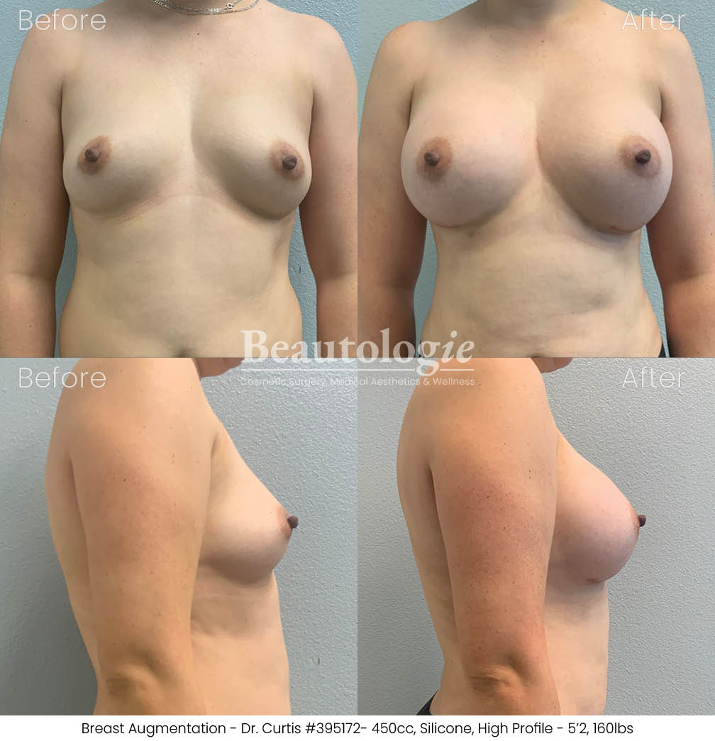 Before-and-afters-breast-breast-augmentation-dr-curtis-42