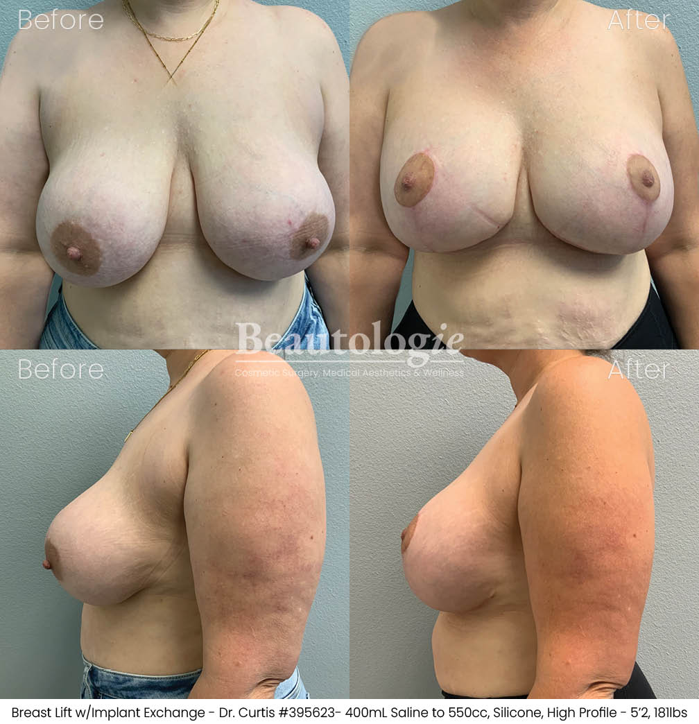 Before-and-afters-breast-breast-lift-dr-curtis-03