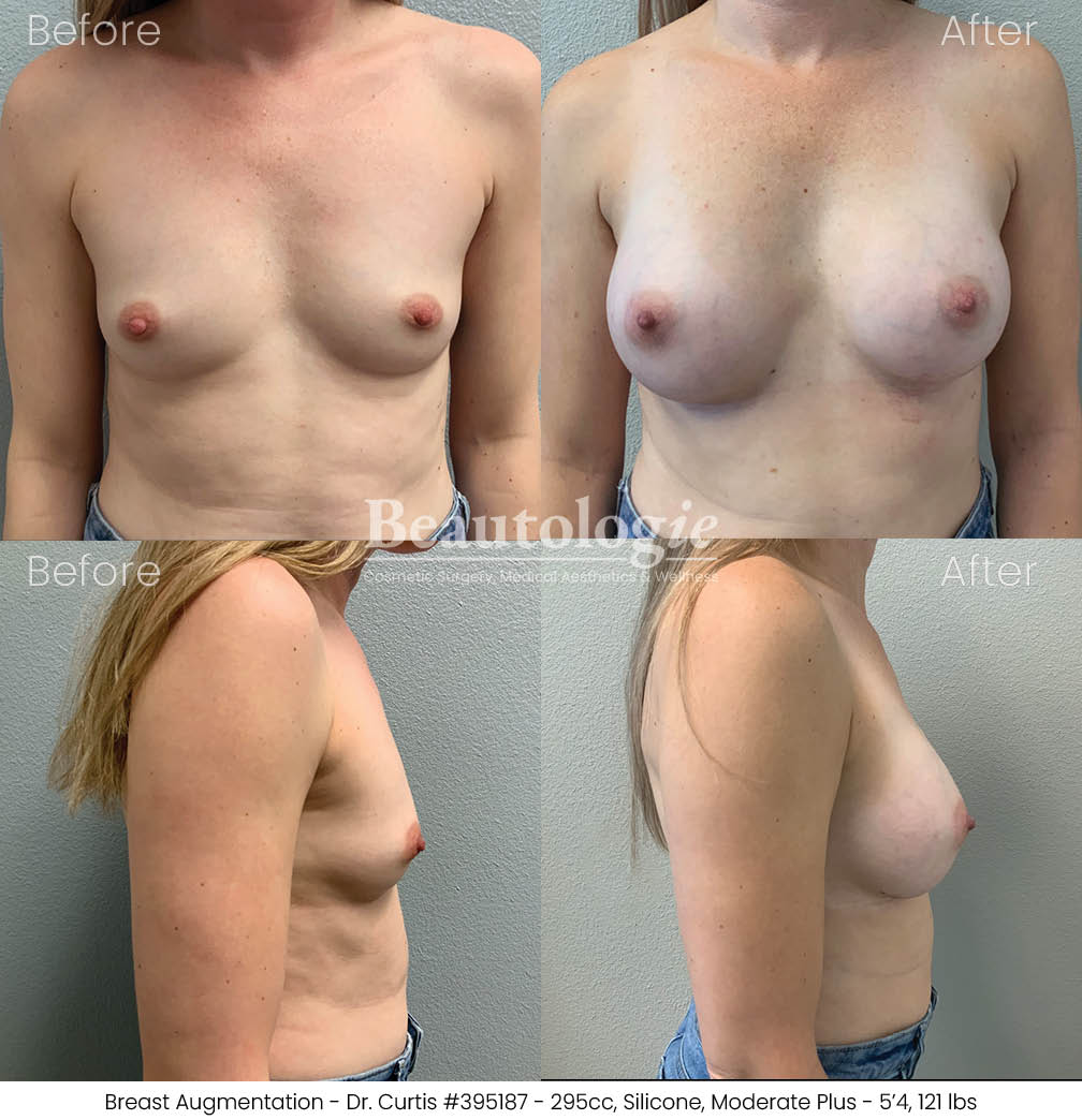 Before-and-afters-breast-breast-augmentation-dr-curtis-43