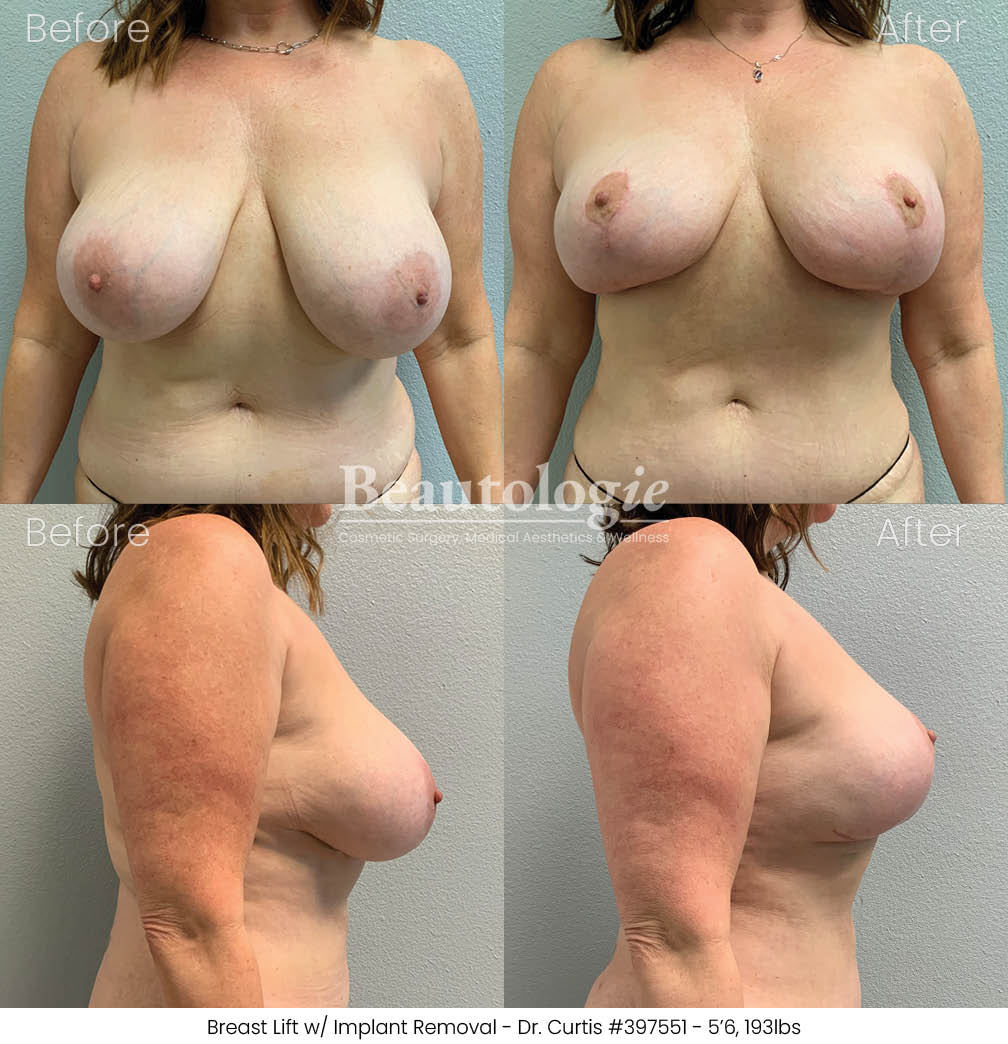 Before-and-afters-breast-breast-lift-dr-curtis-04