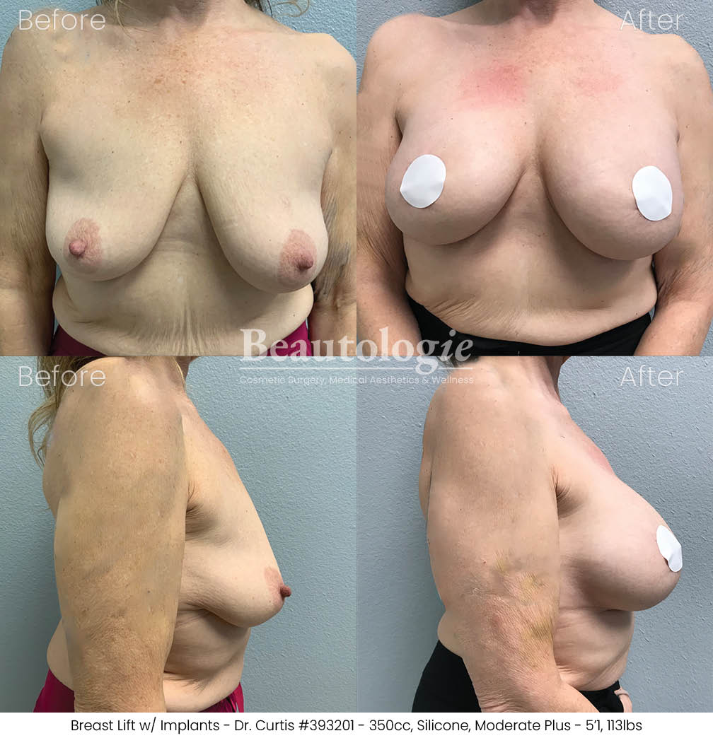 Before-and-afters-breast-breast-lift-dr-curtis-05