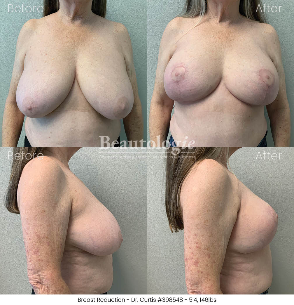 Before-and-afters-breast-reduction-dr-curtis-01