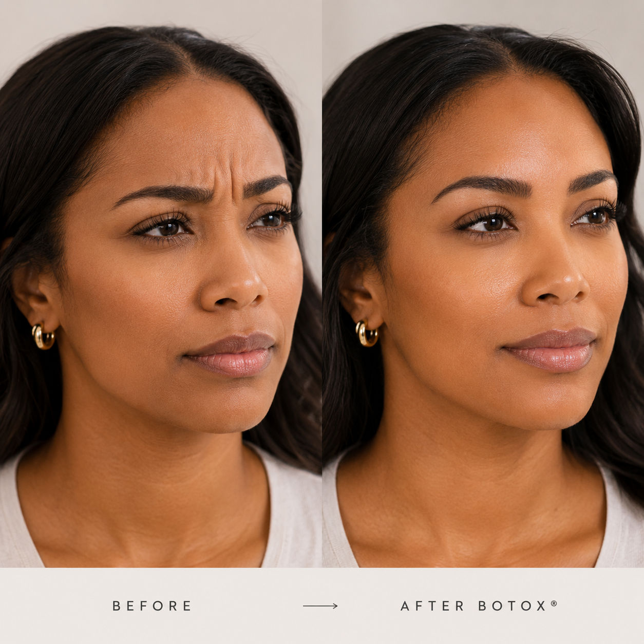 Letybo: The New FDA-Approved Neuromodulator Now Available in Bakersfield