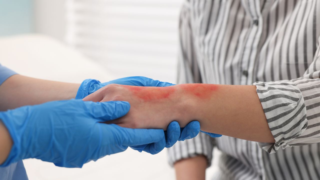 a nurse with a patient with a burned arm