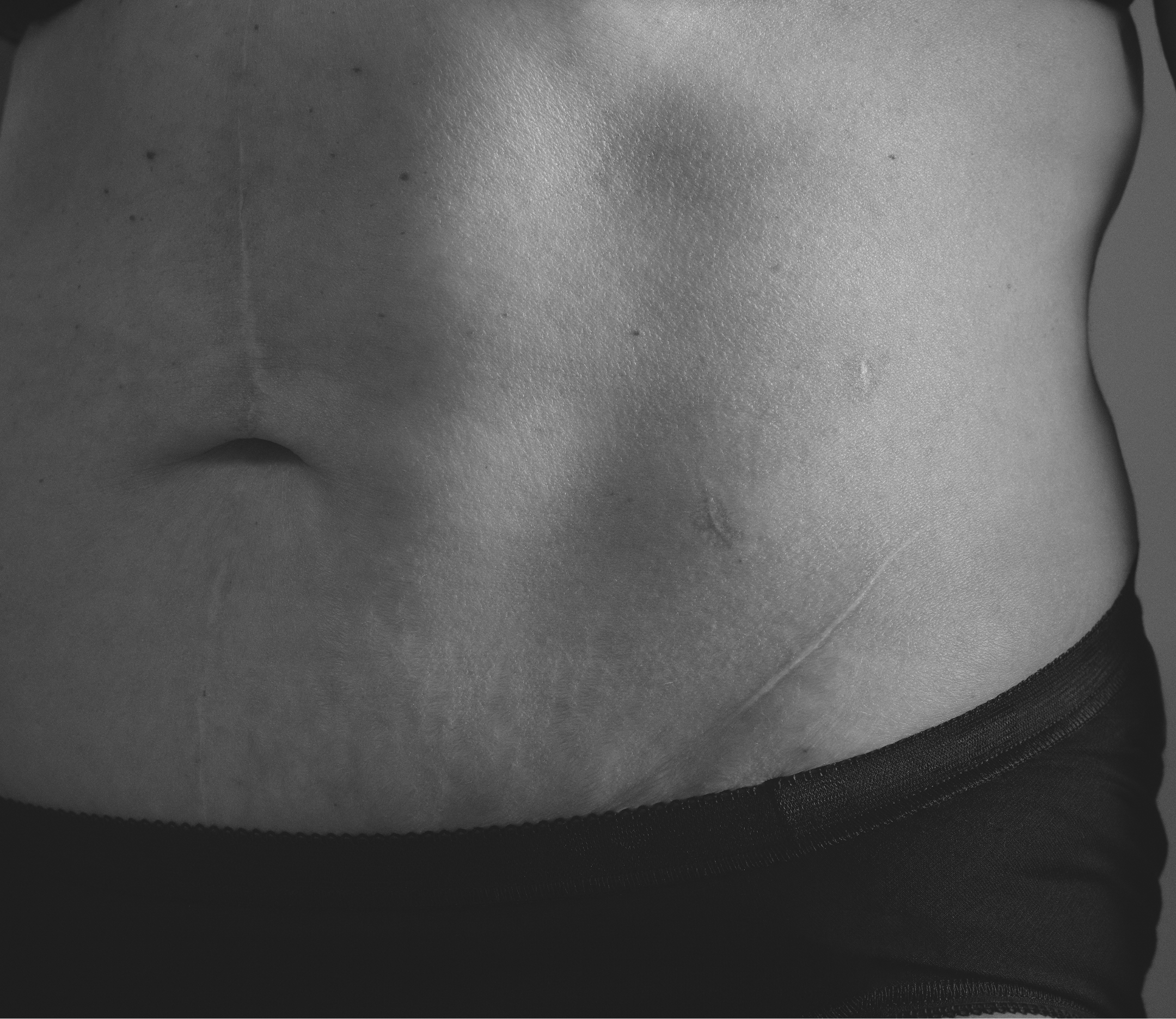 Scar on the abdomen after living kidney donation