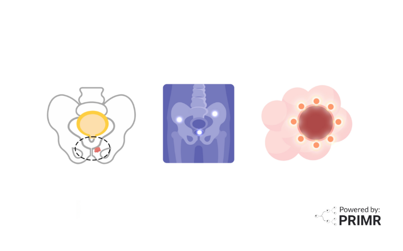 This image is the thumbnail for the blog titled Nuclear Medicine: Understanding PSMA and Its Role in Cancer Care.