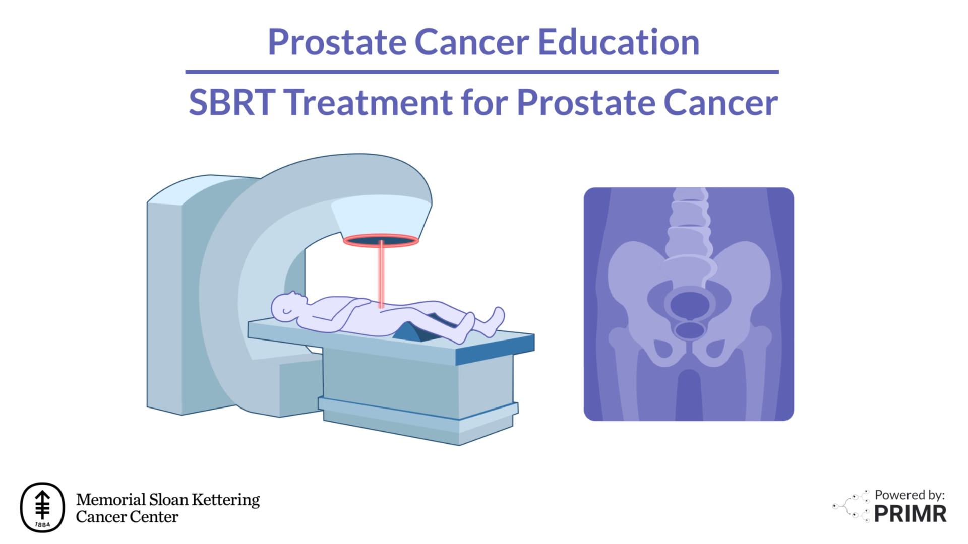 Simple guide to SBRT for prostate cancer patients and families