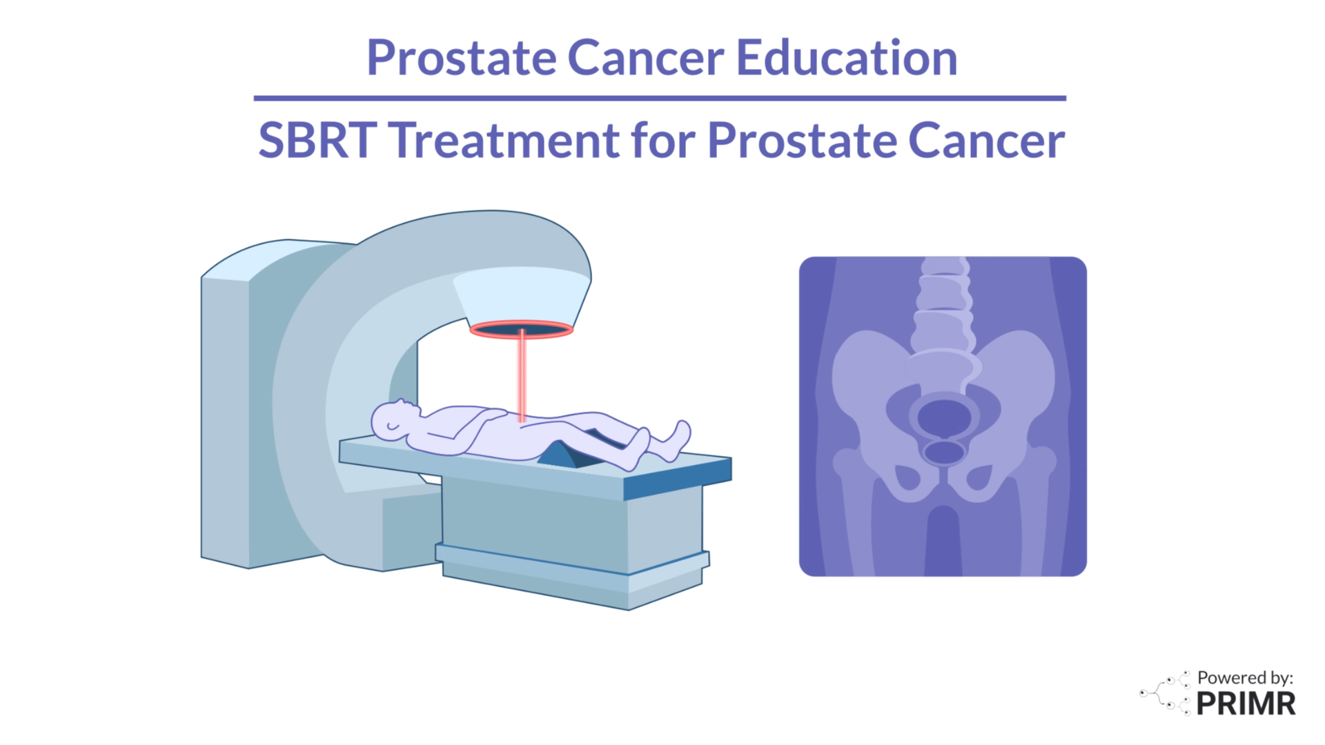 Simple guide to SBRT for prostate cancer patients and families