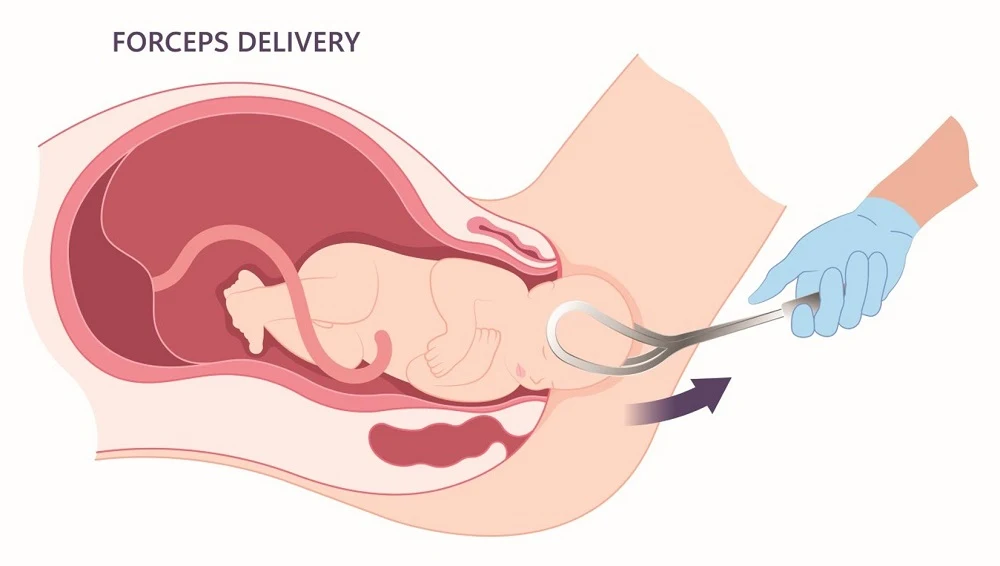 forceps injury lawyer 