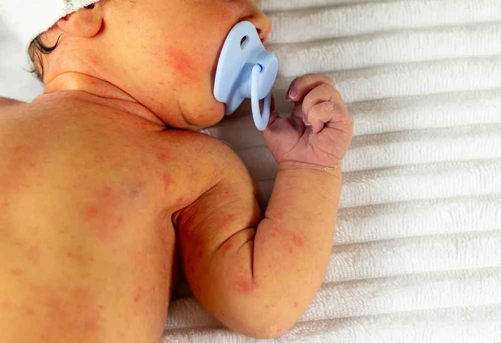 What Is Kernicterus?