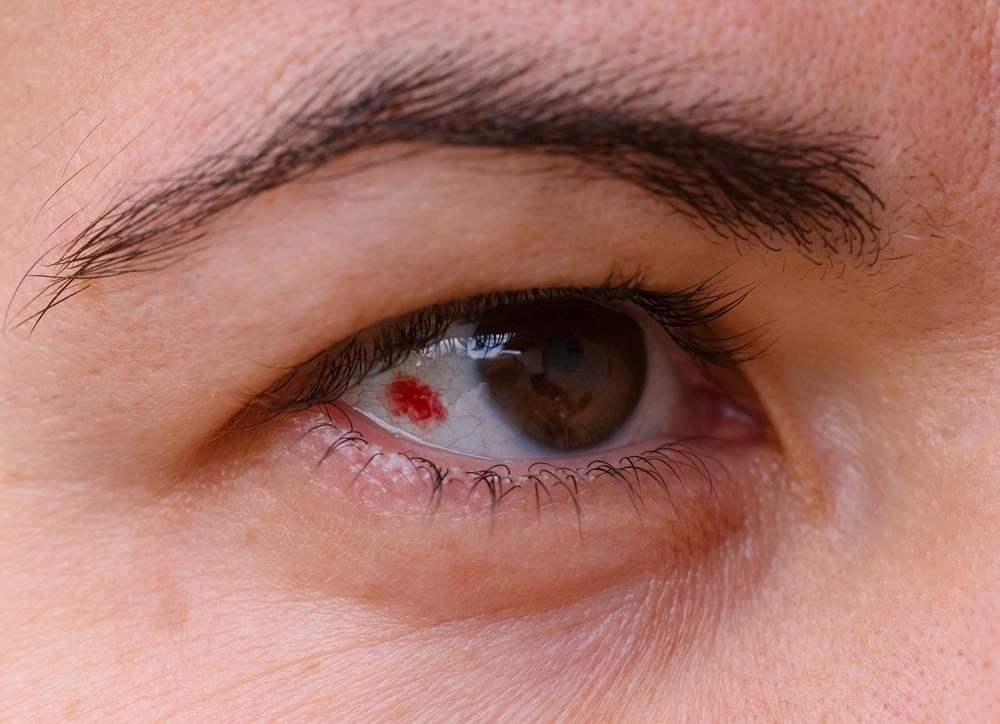 What Is a Subconjunctival Hemorrhage?