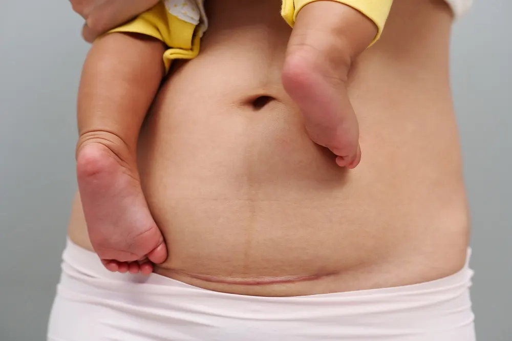 Birth Injuries Due to Delayed C-Section: What You Need to Know