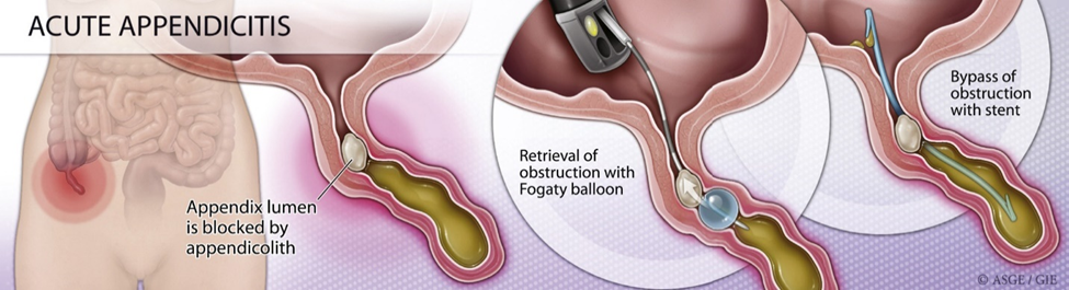Appendicitis Diagnosis