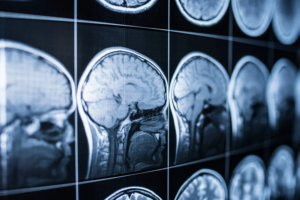 How Medical Malpractice Causes Brain Injuries: Your Legal Rights in NY