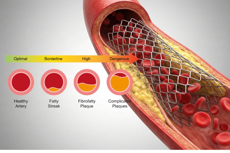 a display of the progression of coronary artery disease