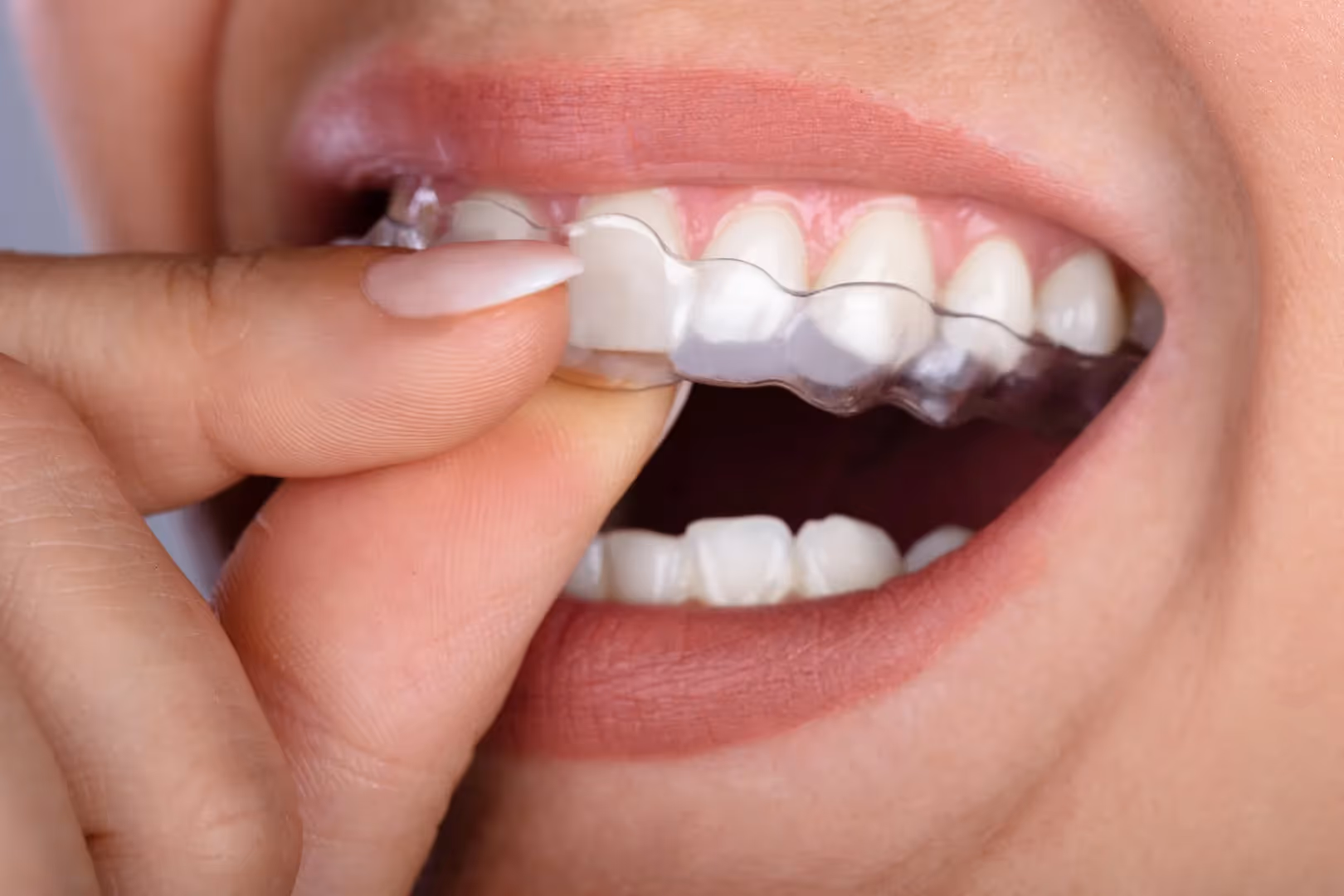 Clear Aligners