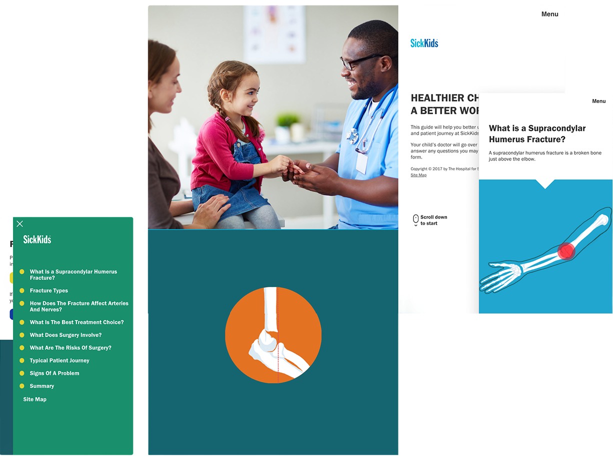 SickKids patient education interface showing a child with a clinician, illustrated medical diagrams of a supracondylar humerus fracture, and a mobile navigation menu with care journey topics.