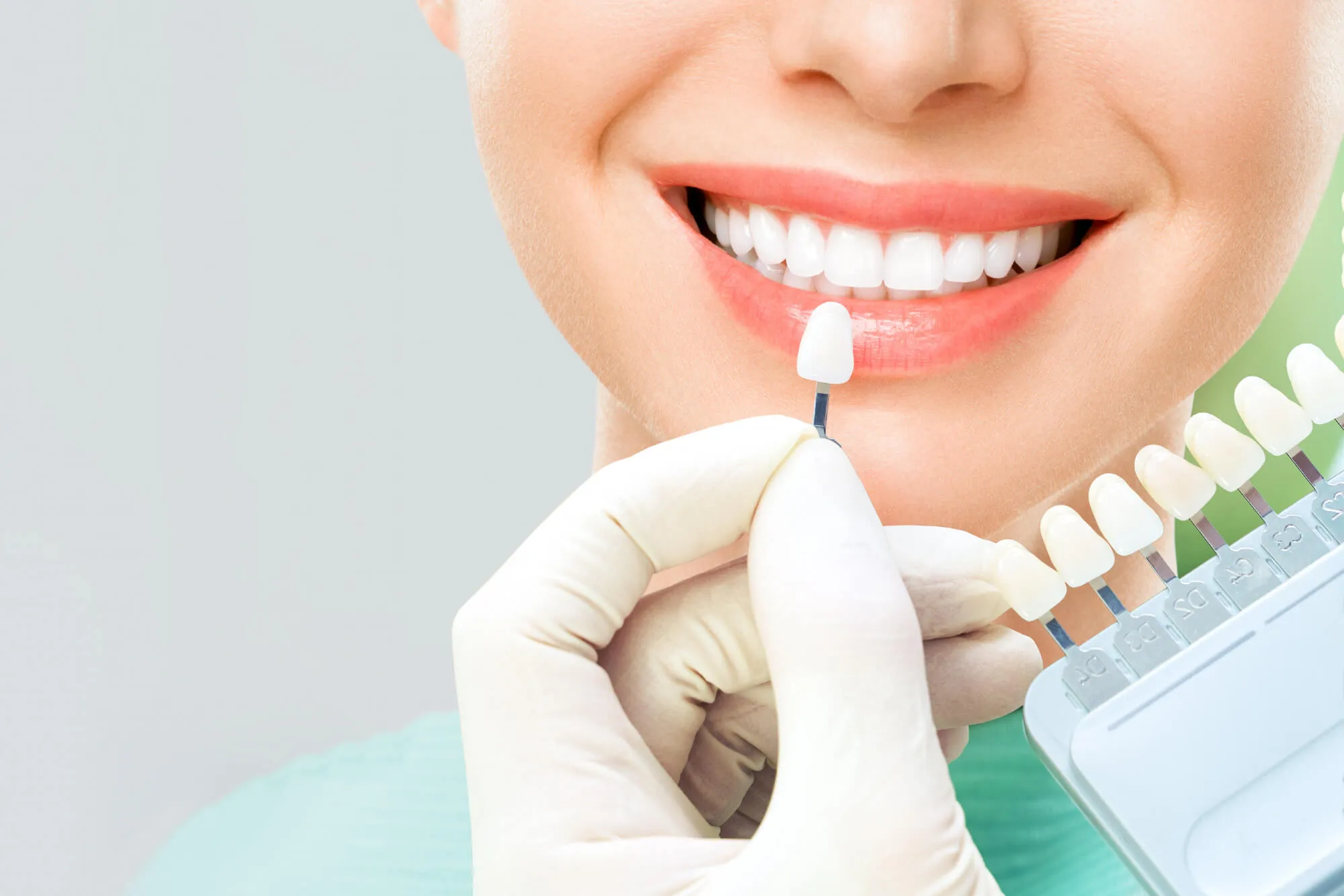 woman smiling with teeth shading guide