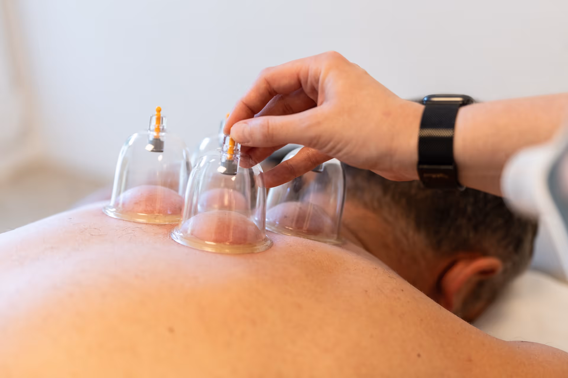 Patient liegt auf dem Bauch auf einer Liege, auf seinen oberen Rücken wurden von einer Therapeutin Schröpfgläser aufgesetzt.