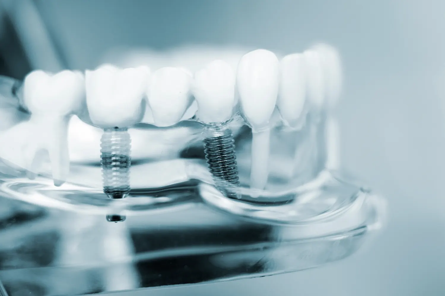 What Can I Eat After Dental Implant Surgery?