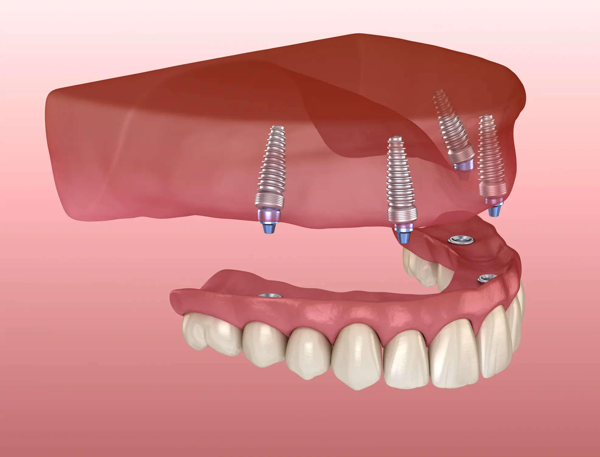 All-on-4 Without Bone Grafting: How Tilting Implants Maximizes Available Bone