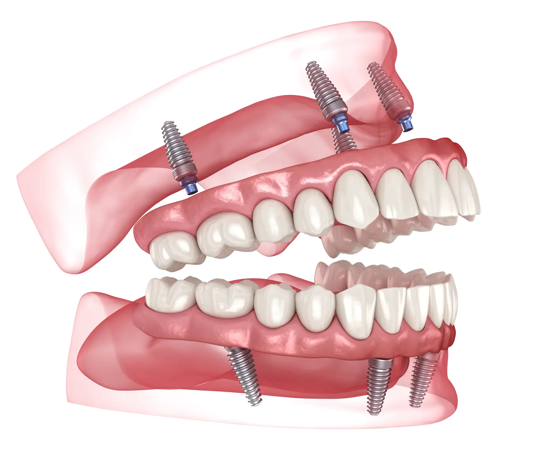 Dealing with Failing Teeth? How Full-Arch Implants Can Save Your Oral Health