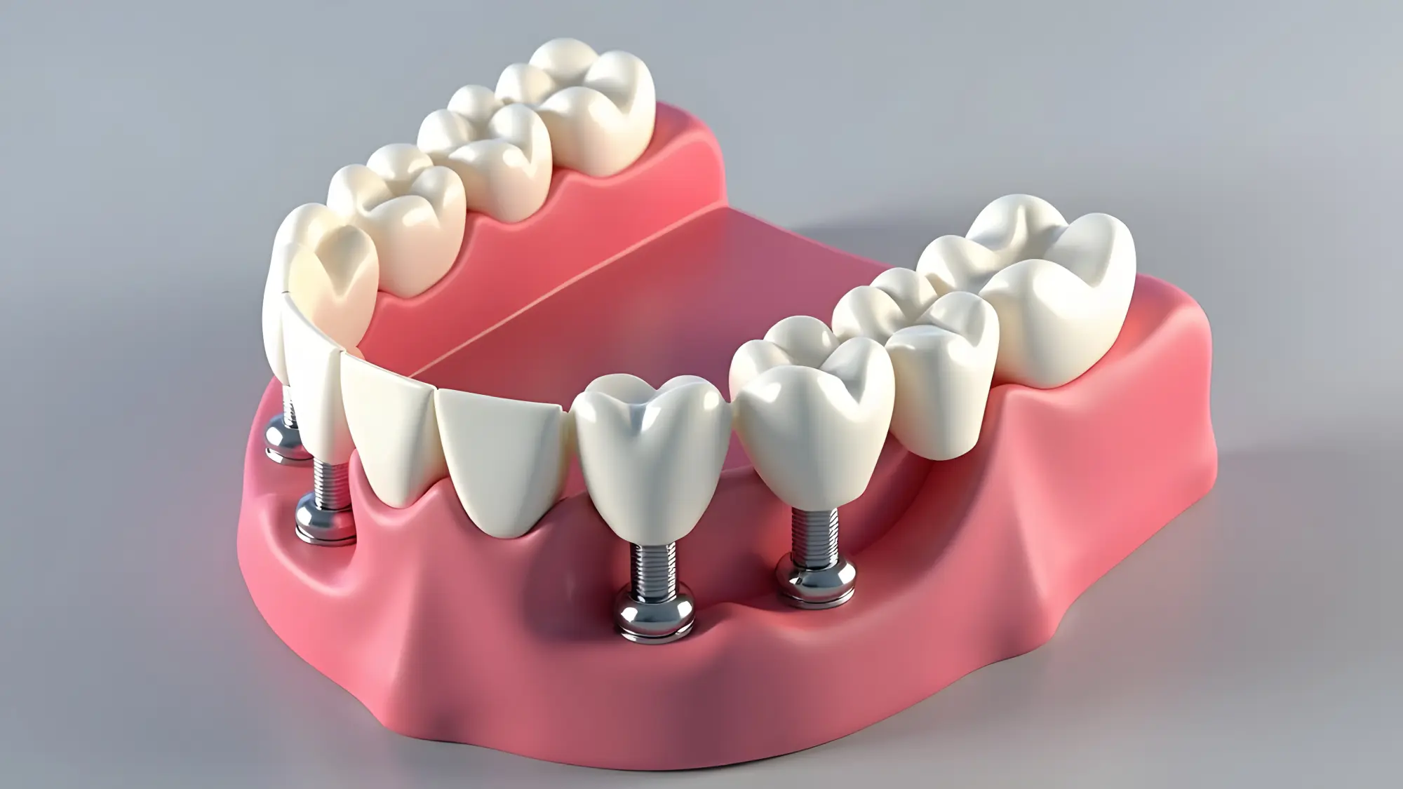 Post-Surgical Care: How to Ensure Your All-on-4 Implants Last a Lifetime