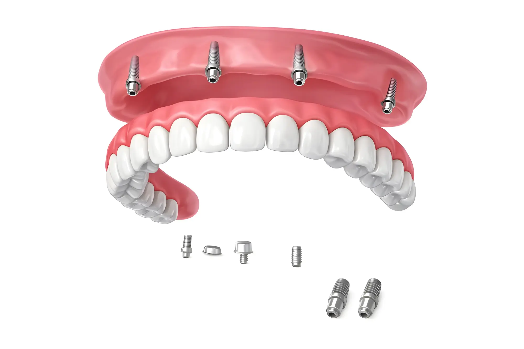 Snap-In Dentures vs. All-on-4: Which Fixed Solution Is Right for You?