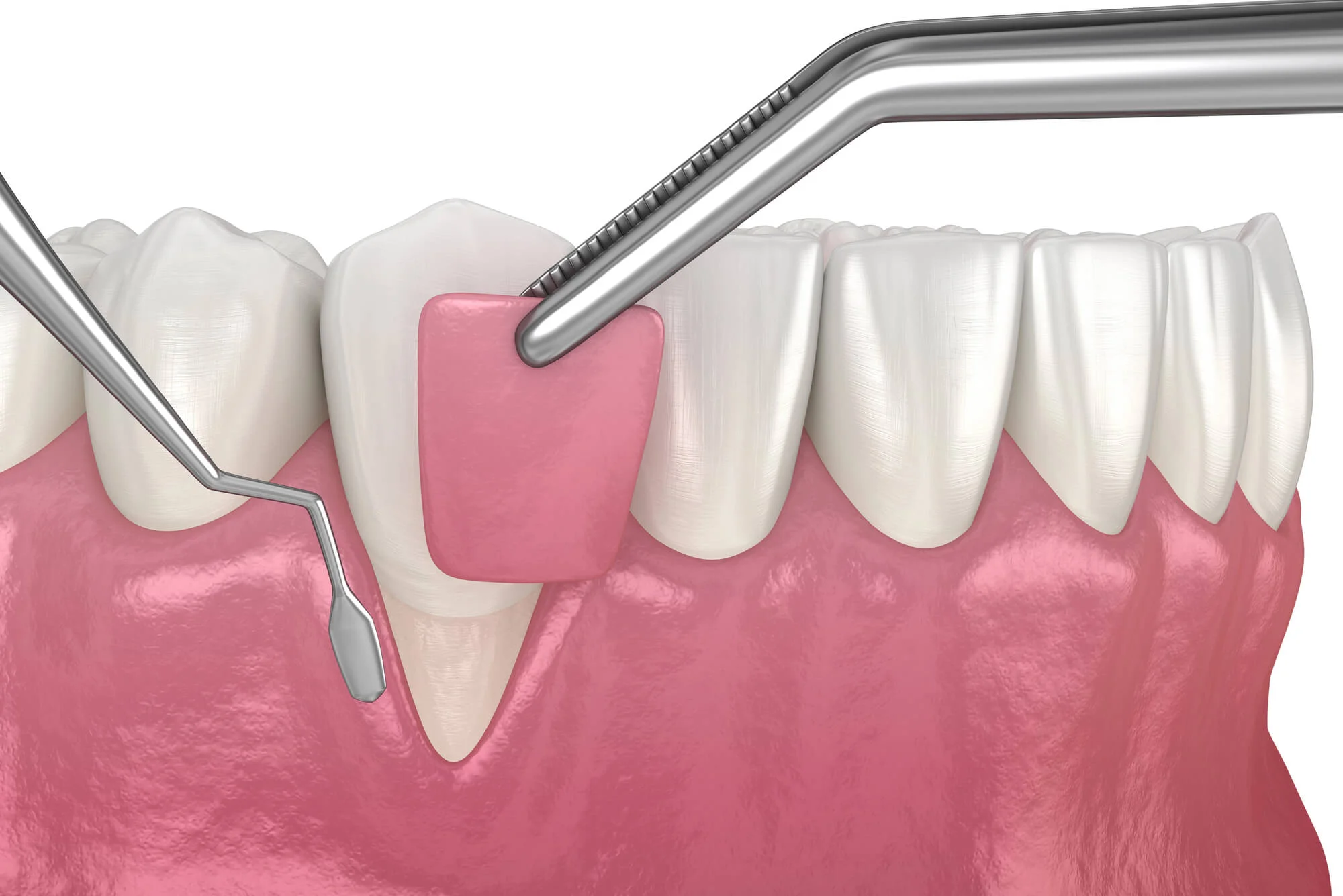 Illustration showing soft tissue grafting in Nashville