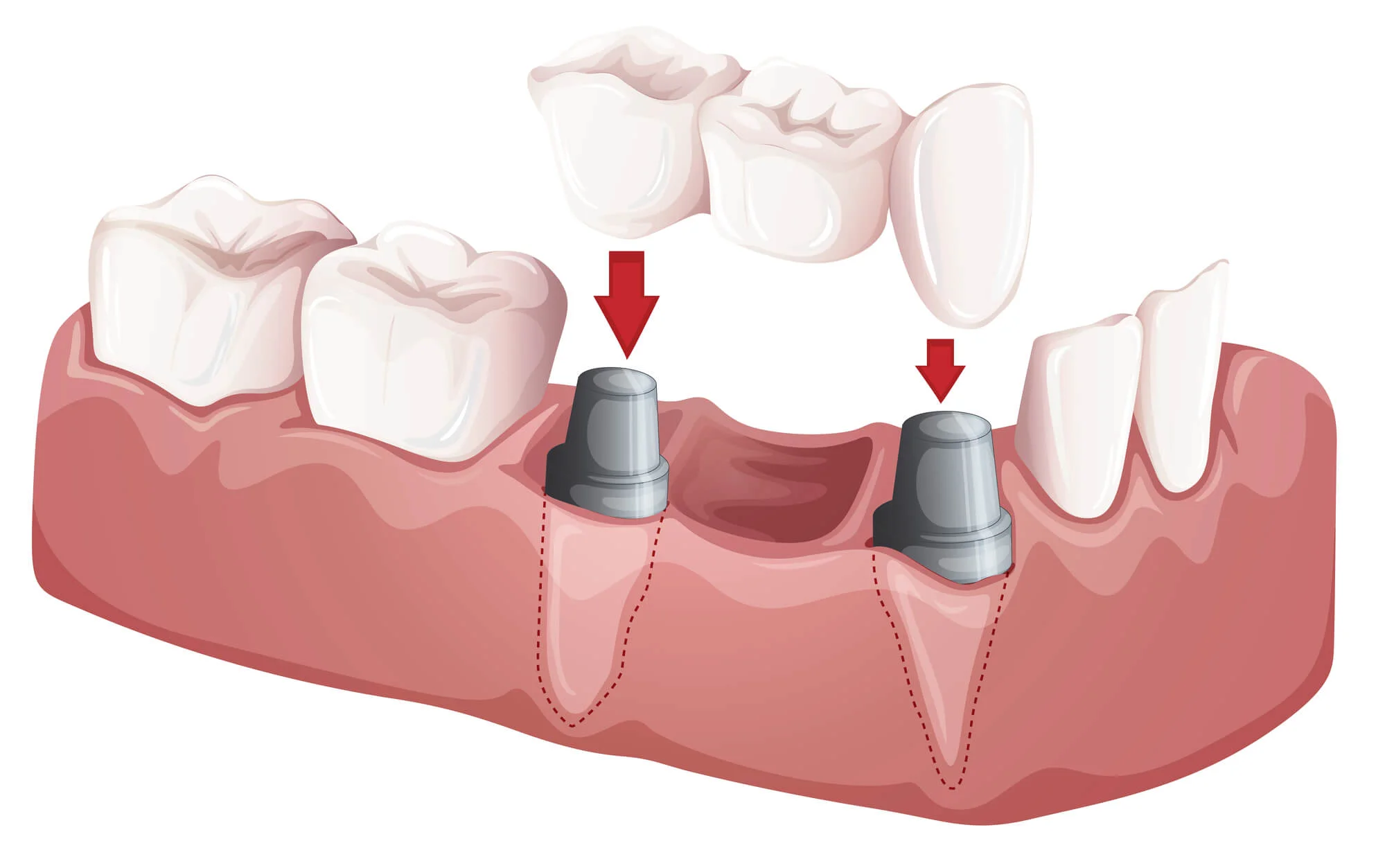 Hybrid dental implant replacement diagram
