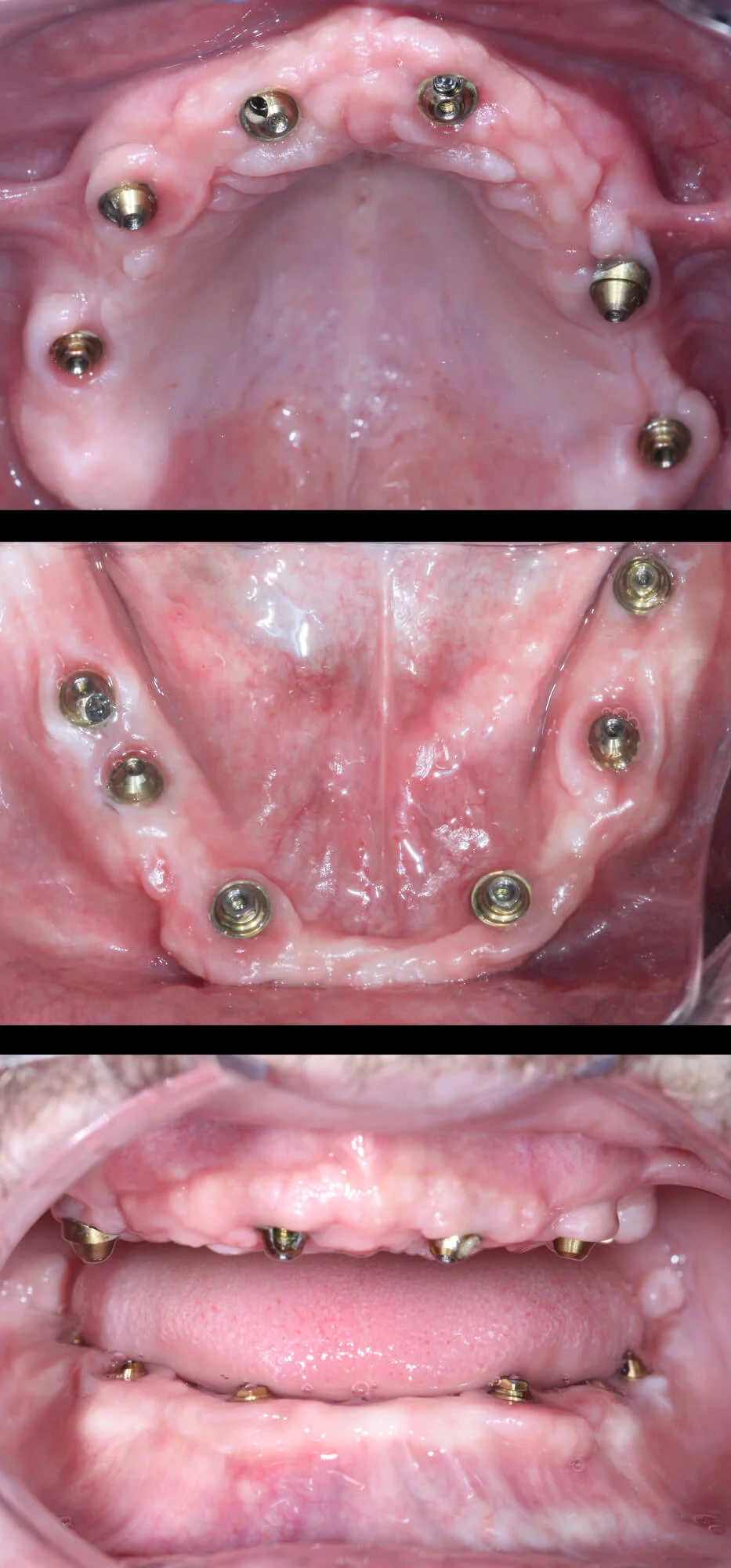 Advanced implant treatment planning for full arch dental implants