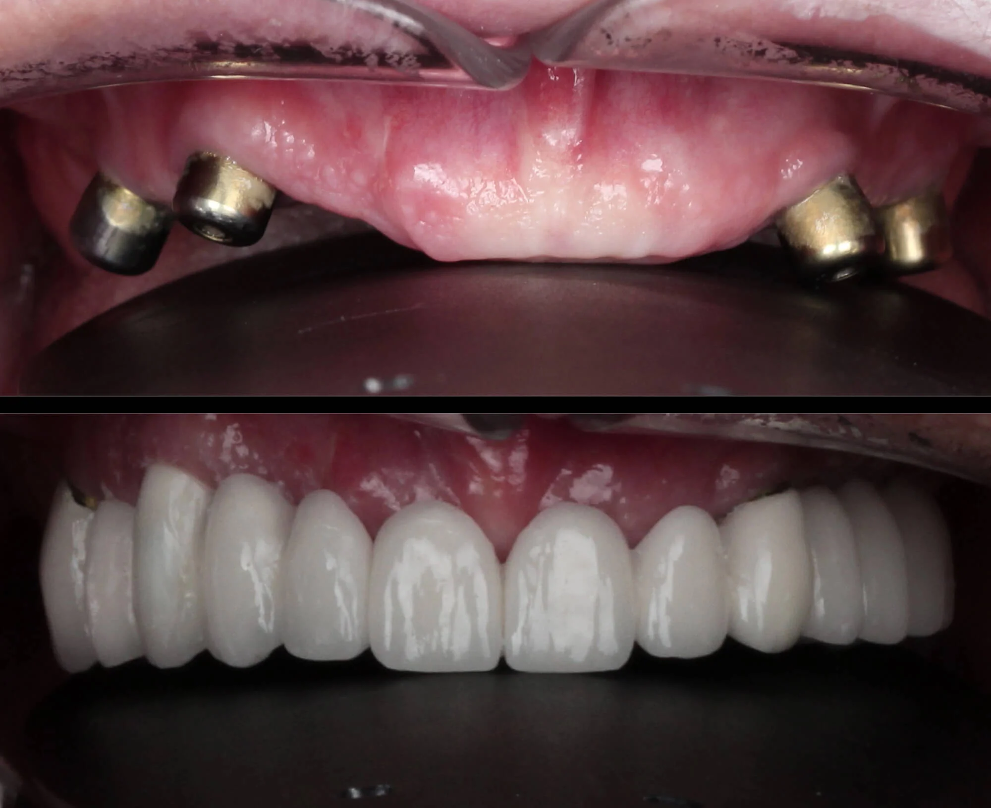 Implant-supported teeth transformation with full arch dental implants