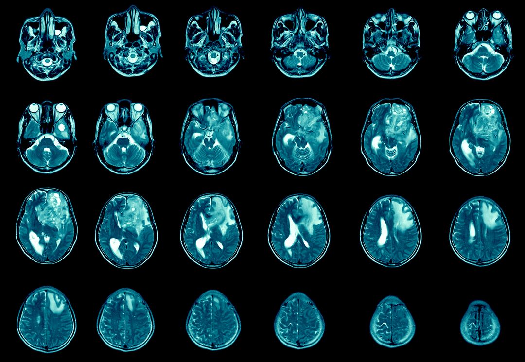 Recognizing the Symptoms of Terminal Brain Cancer - Ezra