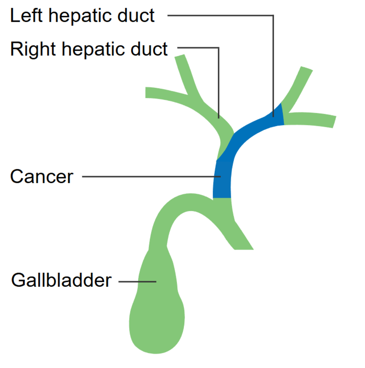 Spotting the Signs: How MRI Can Reveal Hidden Bile Duct Tumours