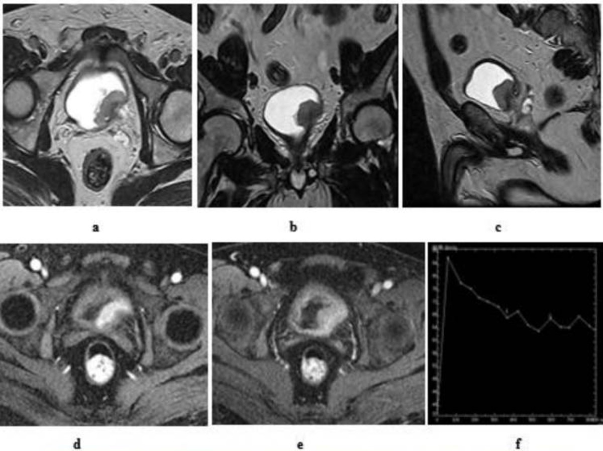 An MRI scan showing a type of muscle-invasive bladder cancer across a number of different sequences.