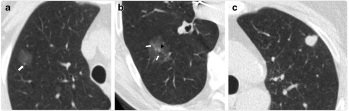 Early Detection: Protecting Your Lungs Through Preventive Screening
