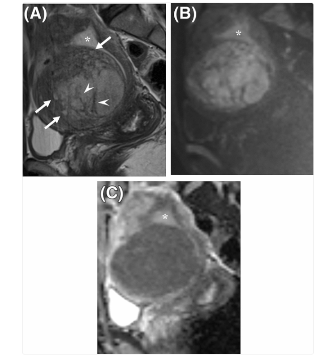 MRI images of endometrial stromal sarcoma.