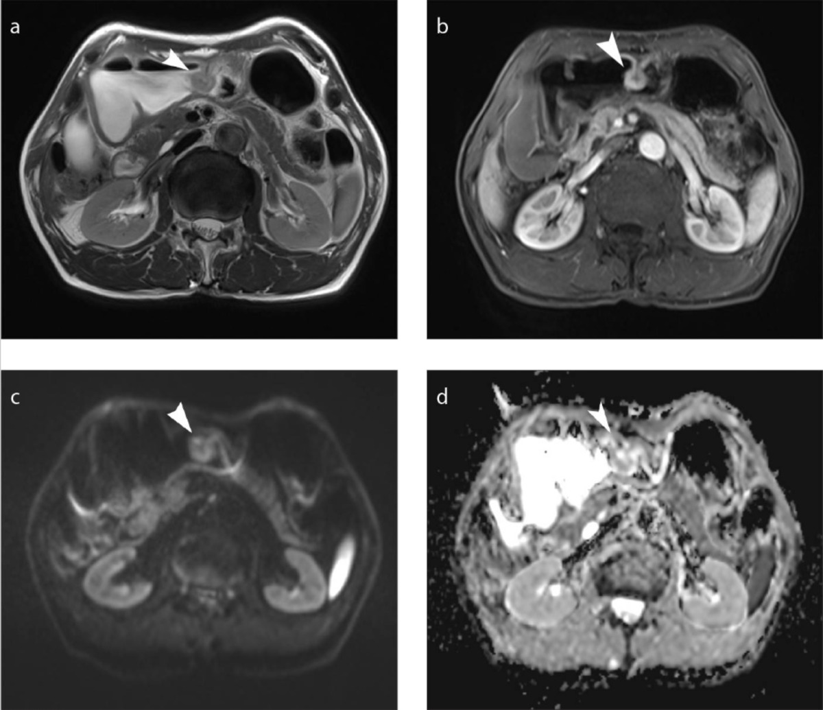 Spotting the Signs of Gastric Cancer Before They Become Serious