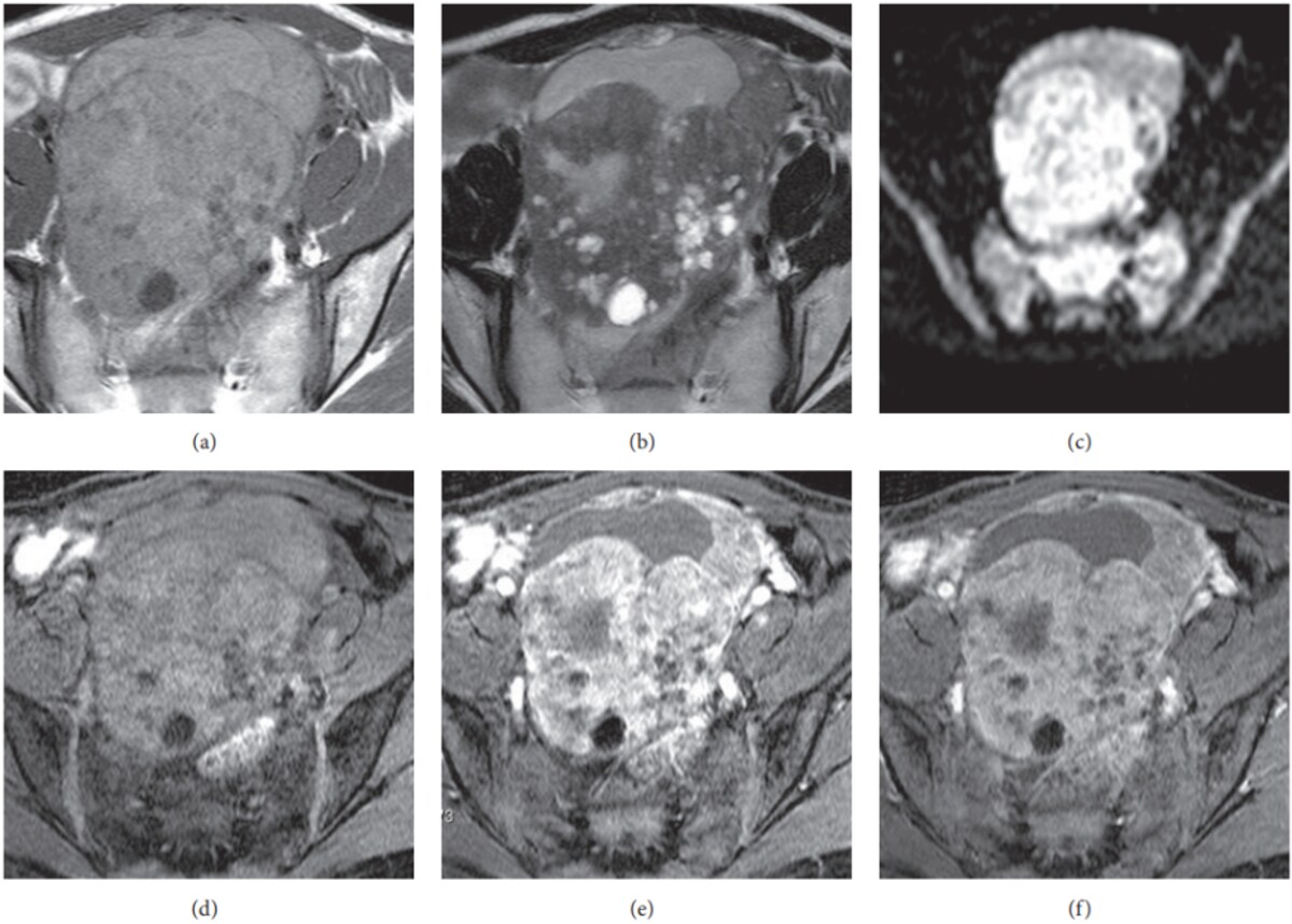 MRI images showing a borderline epithelial tumour.