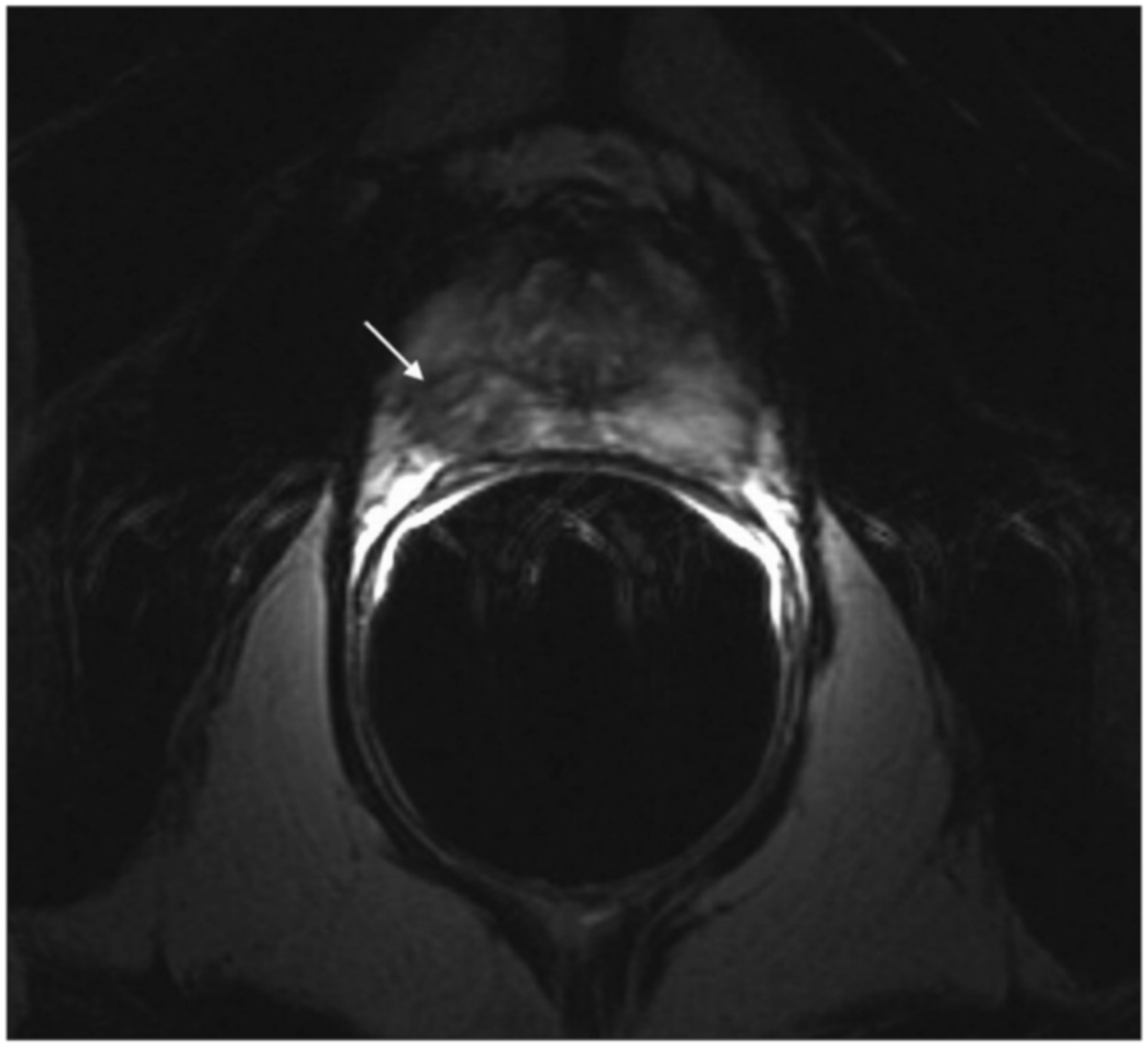 An MRI showing a prostate tumour in the peripheral zone.