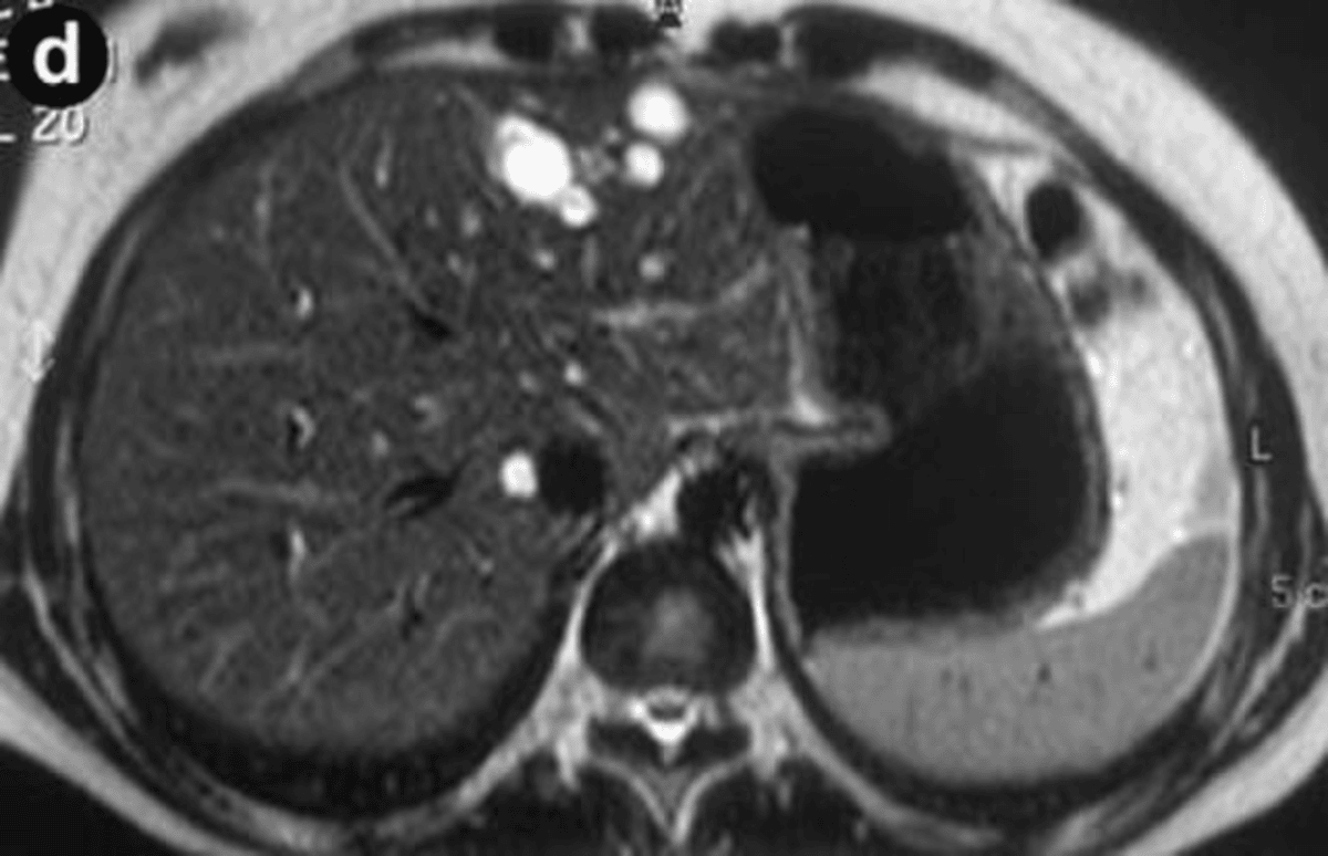 Keto and Fatty Liver – The Surprising Benefits of This Diet