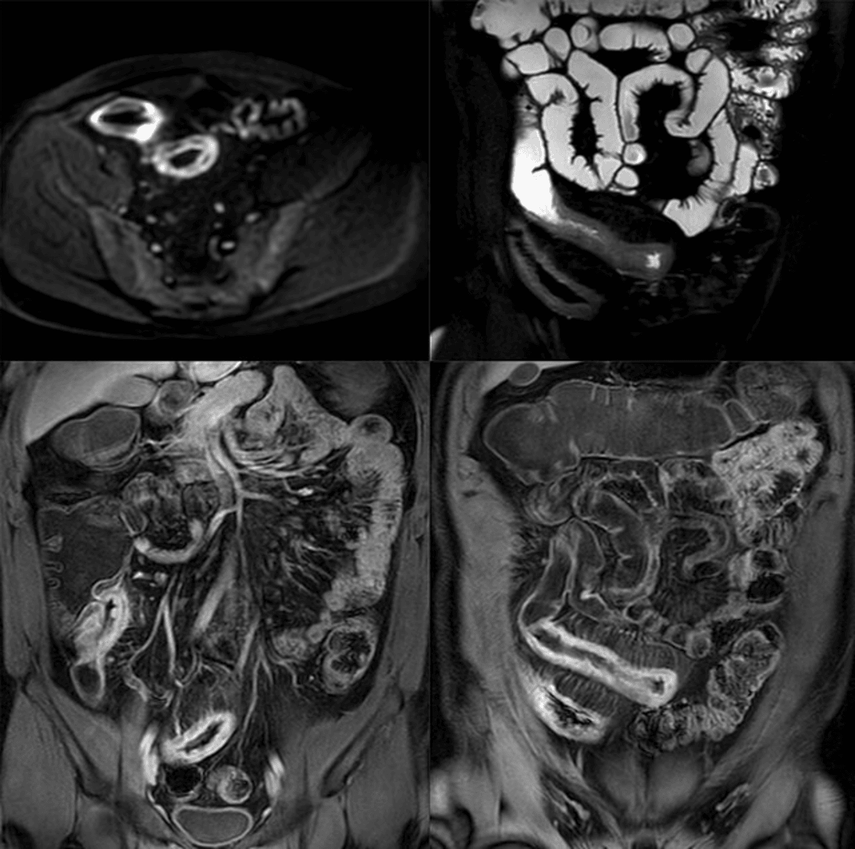 Benefits of Early Detection of Crohn’s and Colitis